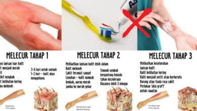 Photo of Tips Melecur Terkena Minyak Panas Atau Api. Jangan Letak 4 Benda Ini!